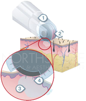DermaFrac