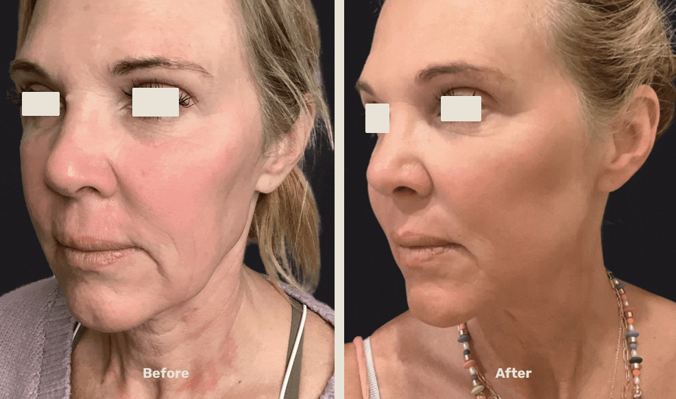 Endolift After Befor