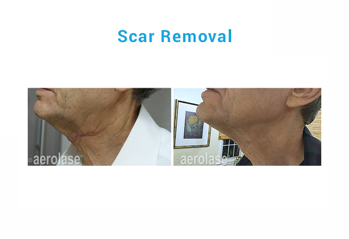 scar removal