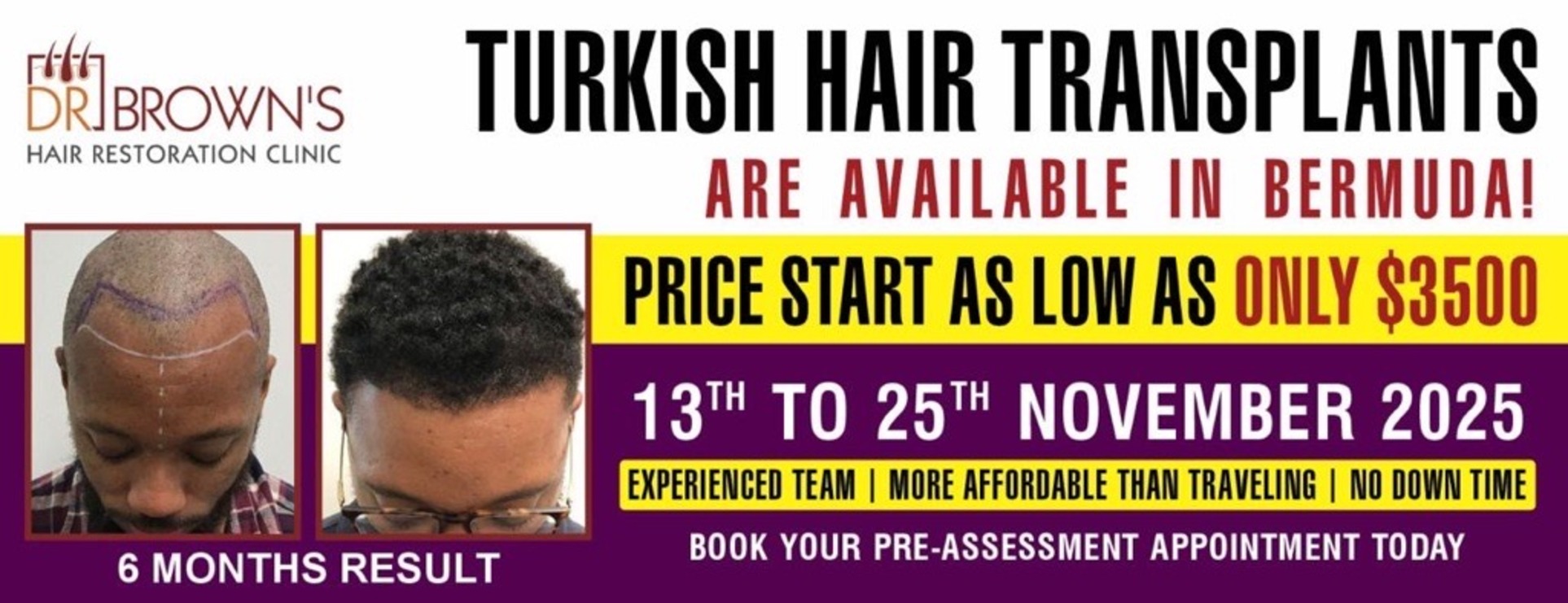 Turkish hair transplant