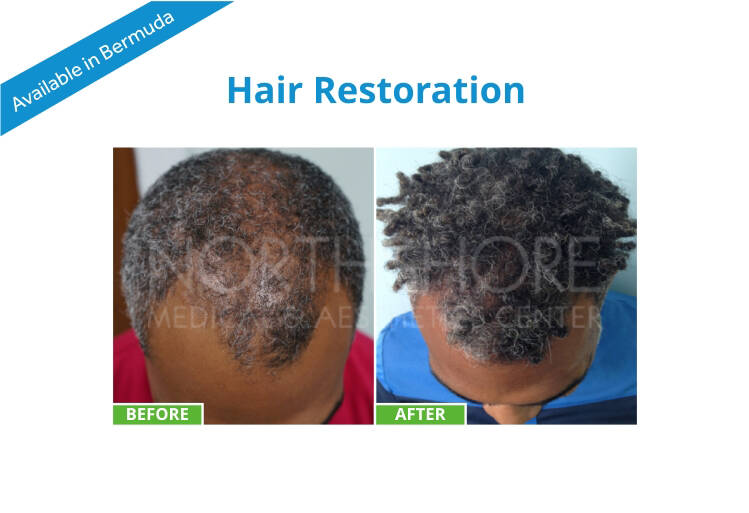 NMAC - HAIR RESTORATION
